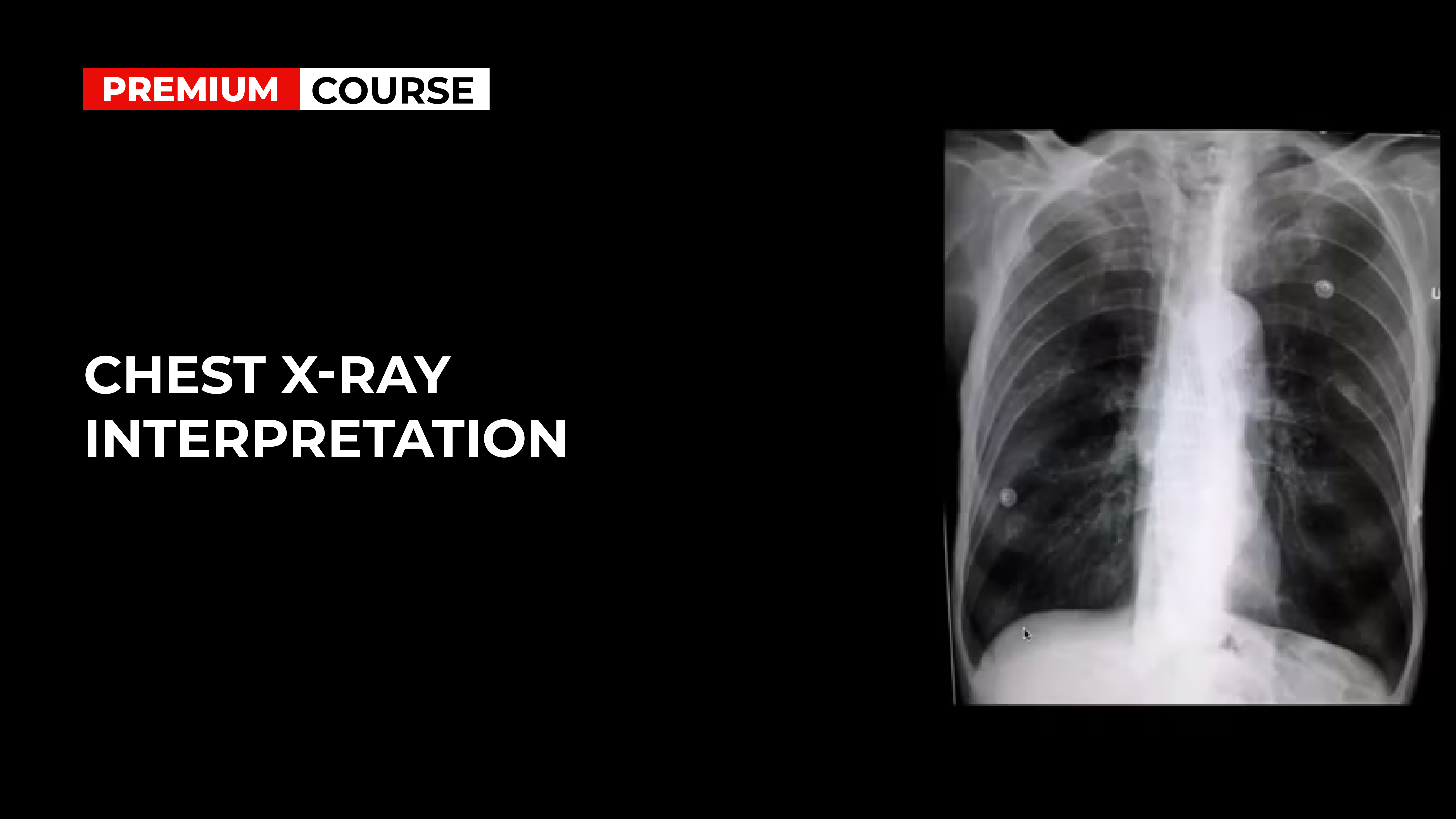 Interpreting A Chest X Ray Abcde at Helen Breen blog